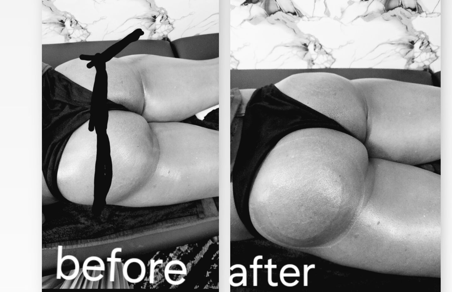 Butt lifting